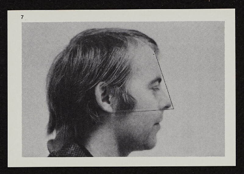 Richards Jarden – Facial Angle 